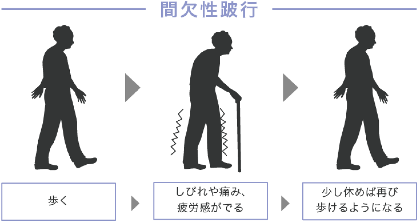 間欠性跛行の症状