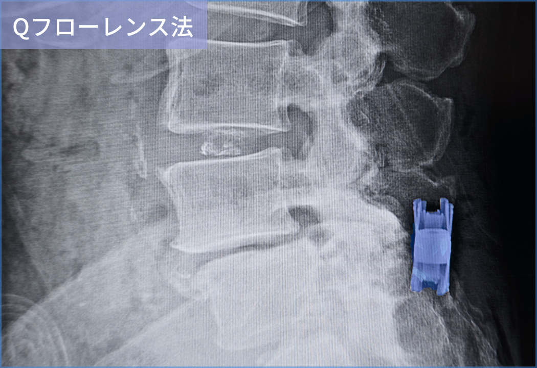 Qフローレンス法の術後のレントゲン